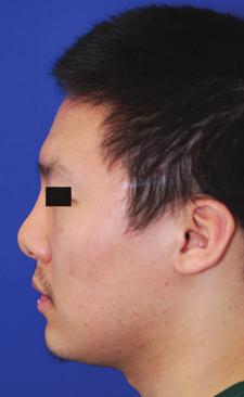 Whether the nose requires a larger bridge or a more pronounced tip region, grafts or implants are frequently necessary for the required changes.