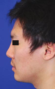 Other cartilage options for augmentation rhinoplasty include rib and donor rib (irradiated costal cartilage).