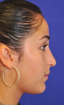 ... Reduction rhinoplasty is the medical term used to describe nasal surgery intended to reduce the overall size of the nose.