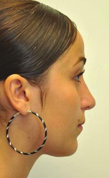 Most patients interested in reduction rhinoplasty, want the bump on their nose to be taken down. This typically refers to the nasal dorsum or bridge of the nose.
