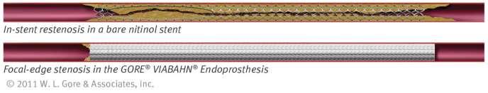 Why using SE covered stents?
