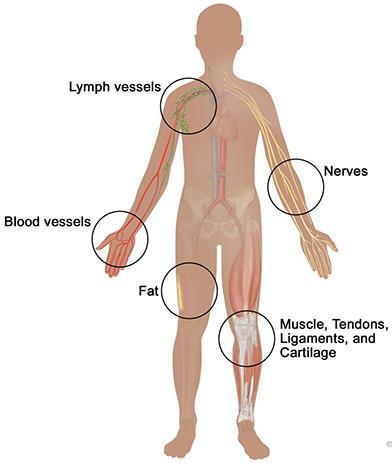 Sarcoma A cancer that starts in the connective tissues of the body, e.g.