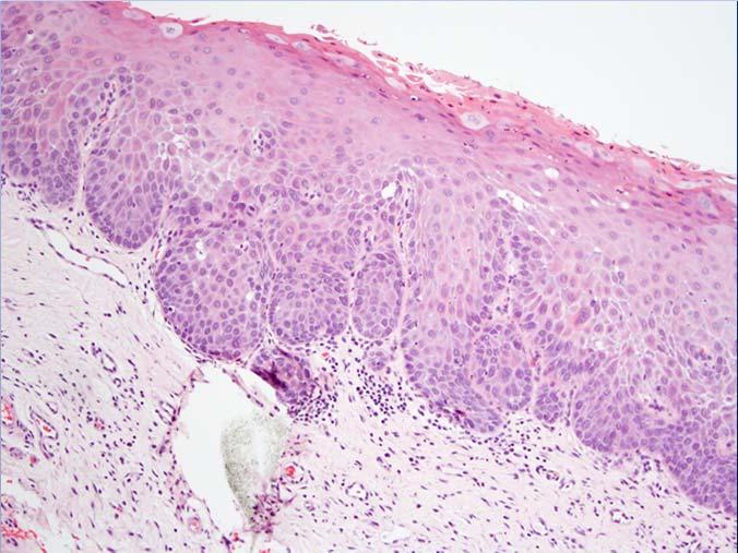 Keratinizing dysplasia features WHO 2017 Criteria for Diagnosing Dysplasia High grade Architectural Disturbances Abnormal maturation Irregular epithelial stratification and