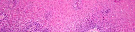 Architectural Disturbances Normal epithelial stratification ; transition of basal cells with