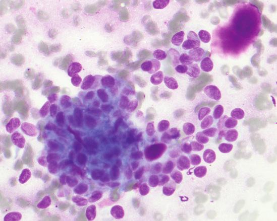4 ISRN Pathology Figure 1: Basaloid cells with mild to moderate pleomorphism and hyaline matrix spheres (Diff Quick stain 200).