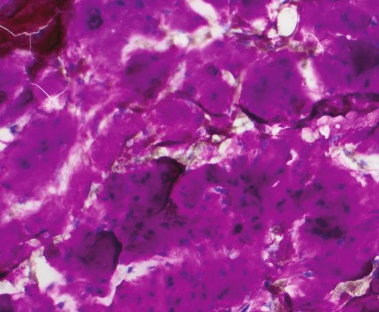 ISRN Pathology 5 Figure 3: Abundant hypercellular chondroid material (Diff Quick stain 200) with many binucleated and occasional trinucleated cells (insert, Pap stain 200).