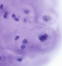 Figure 4: Mature single and clusters of squamous epithelial cells with occasional enlarged atypical cells (Pap stain 200). The cell block showed similar features (insert, H & E stain 200).