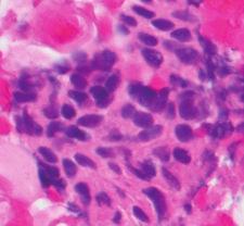 basalcelladenoma/carcinoma,lymphomaandmetastatic basaloid squamous cell carcinoma, or nasopharyngeal carcinoma [11 13].
