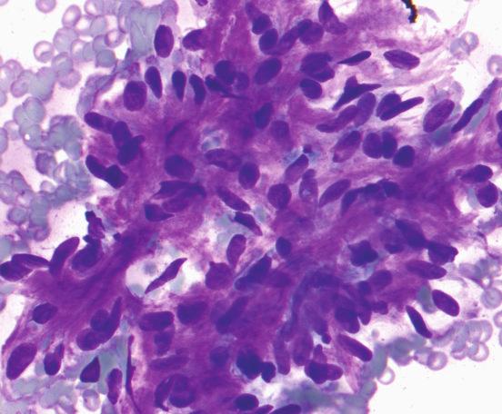6 ISRN Pathology Figure 5: Bland epithelial cells, some with plasmacytoid appearance (Diff Quick stain 200) intermixed with a chondromyxoid stroma (insert, Diff Quick stain 200).