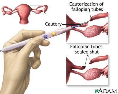 TUBAL LIGATION Surgical procedure performed on a woman Fallopian tubes are cut, tied,