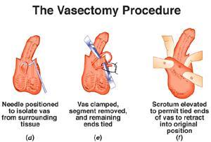 VASECTOMY Male sterilization procedure Ligation of Vas Deferens tube Sperm are absorbed by the
