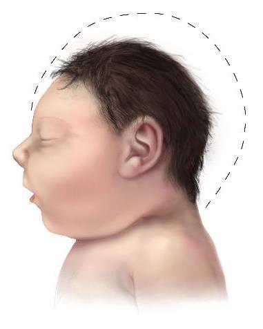 Case definition of microcephaly Head circumference (HC) at birth is less than the 3rd percentile for gestational age and sex.
