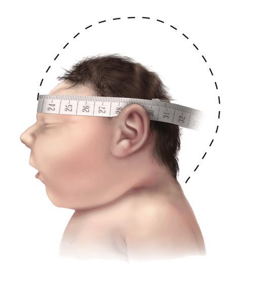 Measuring head circumference Baby with typical head size Baby with Microcephaly Baby with Severe Microcephaly Use a measuring tape that cannot be stretched Take the measurement three times and select