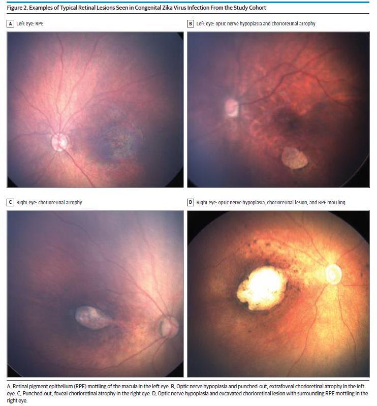 Congenital Zika Eye Disease Retinal Pigment Epithelium Optic Nerve Hypoplasia with Chorioretinal Atrophy Zin AA, Tsui I, Rossetto J, Vasconcelos Z, Adachi K, Valderramos S, Halai U, Pone MVDS, Pone
