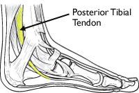 Posterior Tibial Tendon Dysfunction Page ( 1 ) Posterior tibial tendon dysfunction is one of the most common problems of the foot and ankle.