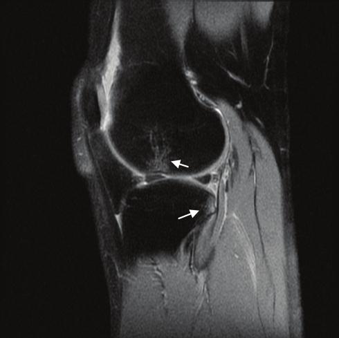 Compression and tension are the two basic loads that act on the knee. MRI findings can reveal the traumatic mechanisms in many acute knee injuries.