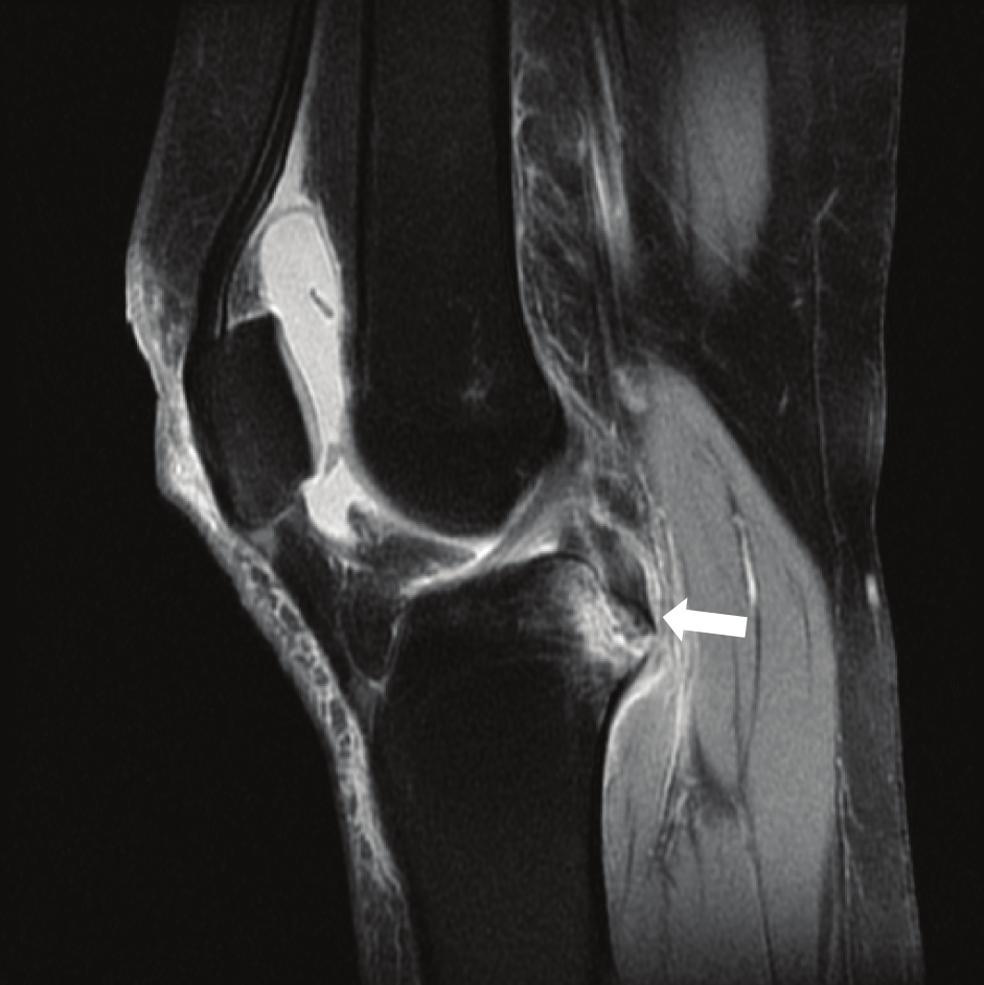 Hemanth Purigali Naganna et al., MRI Diagnosis of Anterior Cruciate Ligament Tears www.ijars.net The mean ACL angle was 23º in complete tear and 41º in partial tears.
