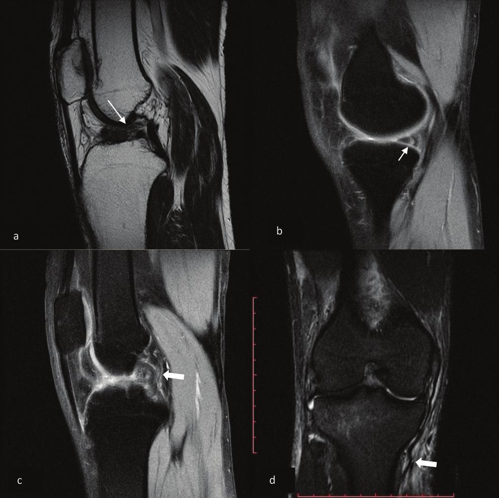 Mean anterior tibial displacement was 9 mm in complete tears and 6 mm in partial tears. Gentili A et al.