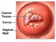 Disorders of the female reproductive system Cervical Cancer Major cause of cervical cancer is HPV (human papillomavirus). HPV is the most common sexually transmitted infection (STI).