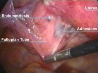 Disorders of the female reproductive system Endometriosis Tissue resembling the inner layer