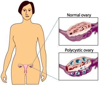 The primary cause is unknown Classic symptoms: menstrual abnormality, polycystic