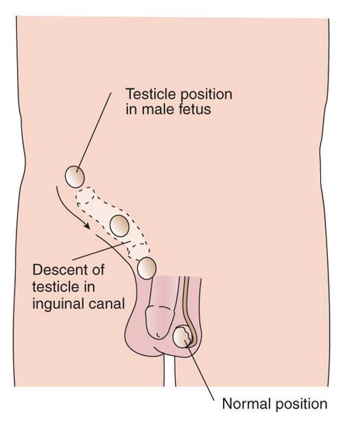 Disorders of the male reproductive system and their treatments Cryptorchidism undescended testes a testicle that hasn't moved into its