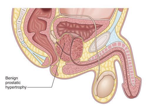 Disorders of the male reproductive system and their treatments Benign prostatic hypertrophy (BPH) enlarged prostate
