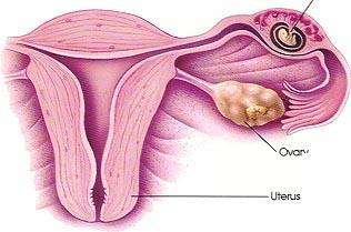 Disorders of the female reproductive Ectopic pregnancy system Is when the fertilized egg stays in the fallopian tube.