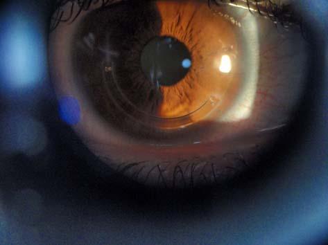 Right eye slit-lamp view demonstrates Intacs implant in inferotemporal region.