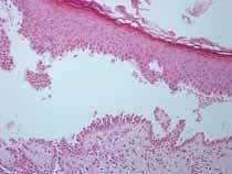 In addition, many patients with PNP have ocular mucosal lesions and pseudomembranous Overview Pemphigus is a group of autoimmune blistering diseases of the skin and mucous membranes which are