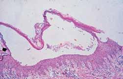 IgA pemphigus is ized by tissue-bound and circulating IgA autoantibodies that target the desmosomal proteins or unidentified cell surface antigens in the epidermis.