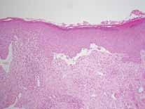 Figure 4 Histopathology Skin lesion Direct immunofluorescence Dermatitis herpetiformis (Dühring disease) Dermatitis herpetiformis (DH) is characterized by chronic eruptions typically on elbows,