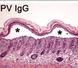 clinical blistering PV IgG GTPase RhoA Phosph.