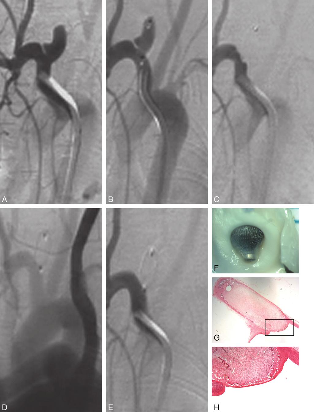 Fig 2. Representative case 5 in the Table. A, Pretreatment DSA demonstrates the aneurysm. B, DSA immediately after placement of Luna AES shows some cessation of intra-aneurysmal flow.