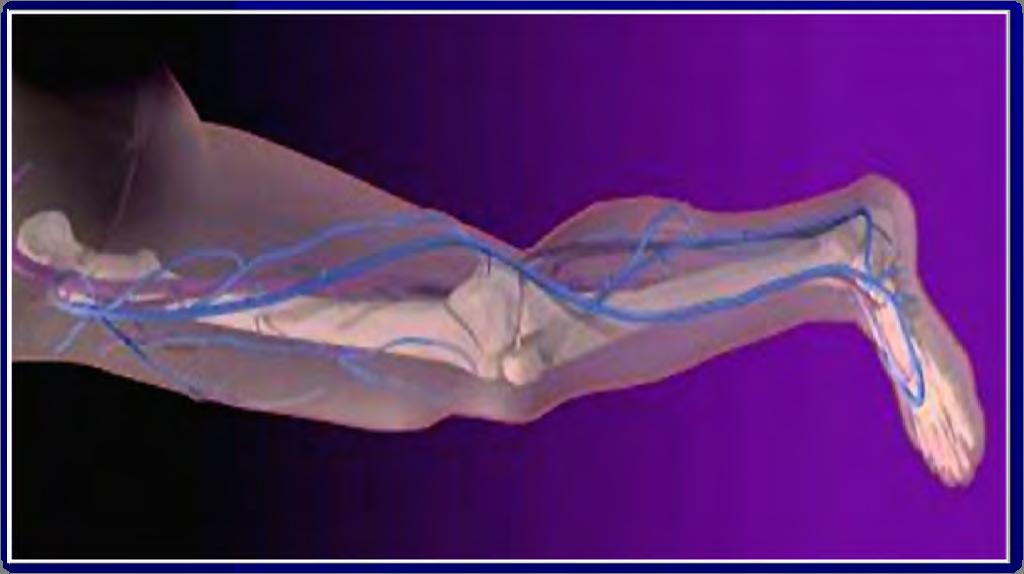 Circumflex Iliac Vein Saphenofemoral Junction Common Femoral Vein Anterior Circumflex Vein of Thigh Posterior Accessory Saphenous Vein of Thigh Anterior Accessory Saphenous Vein of Thigh Superficial