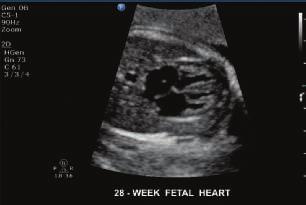 Seeing is believing 28-week fetal heart 17-week fetus Ductal arch The C5-1