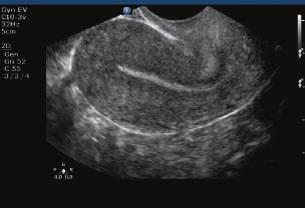 Fetal liver/lung 13-week chorod plexus Endometrium The C5-1 transducer uses