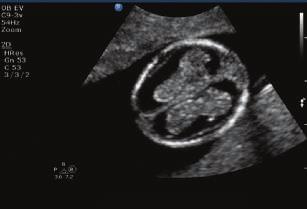 Its PureWave technology provides excellent image quality of the fetal brain as