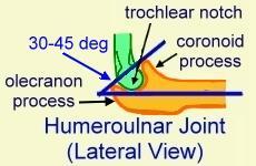 crown) Distal component: ulna saddle-shaped trochlear notch olecranon process coronoid process hourglass Bony Prominence of Elbow Bony prominence gives attachment to the muscle medial epicondyle: for