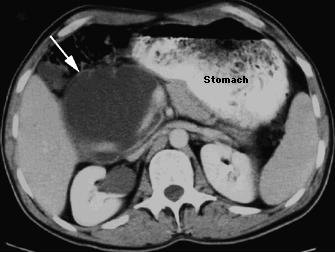 Cystic lesions of the Pancreas: Pseudocyst Pseudocysts Secondary to pancreatitis Variable size