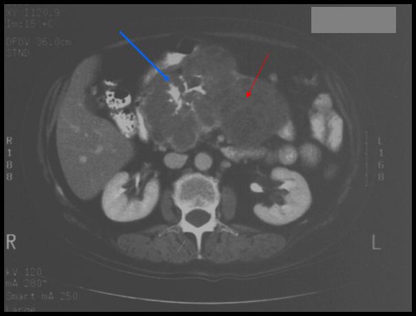 Computational Tomography (CT) of the Abdomen Patient KS Stellate calcification in pancreas