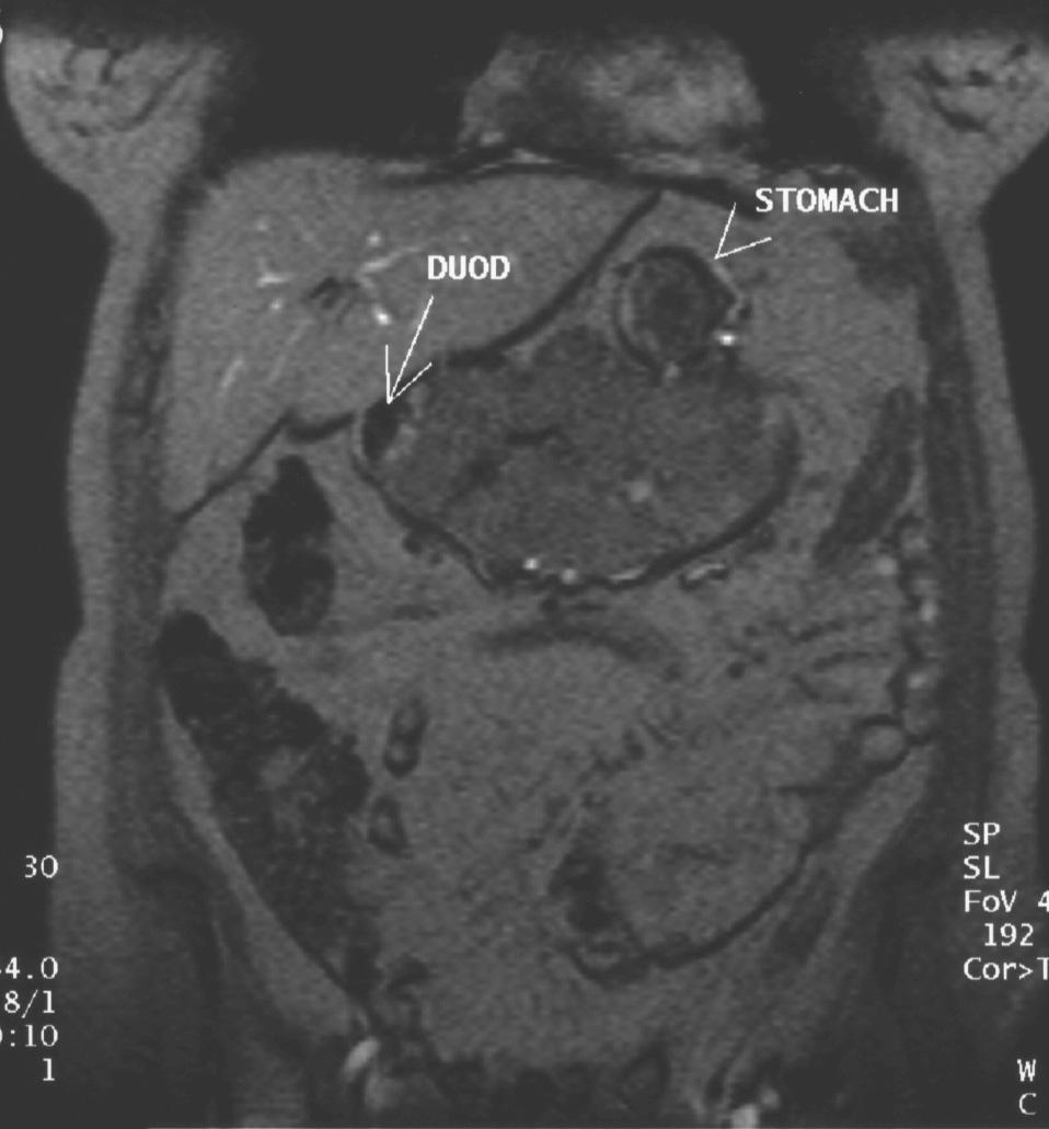 Reconstruction CT of the Abdomen Patient KS Symptoms from mass