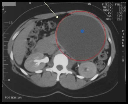 Abdominal CT Patient MG * unilocular cyst No septa!