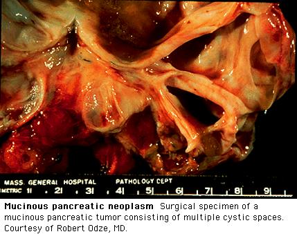 Gross Pathology Patient MG * From: www.uptodate.