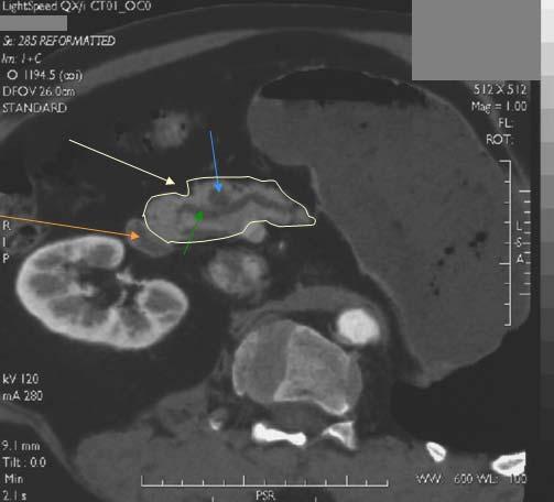 Computational Tomography (CT) of the Abdomen Patient JT Pancreas Cyst Dilated