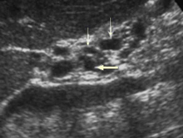 Ultrasound Side Branch Variant Cysts on side branches Not