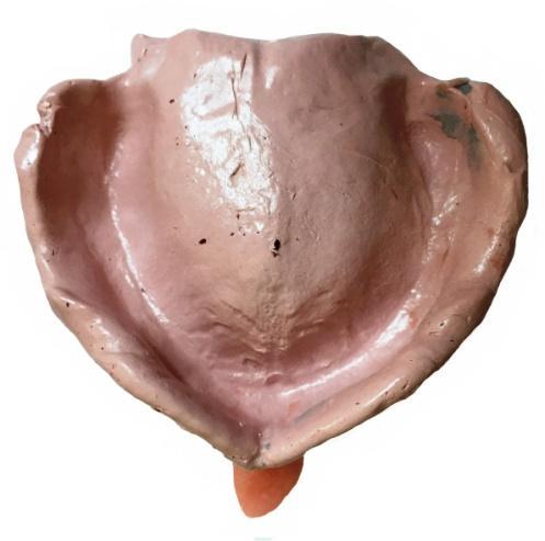 The patients were selected according to the inclusion criteria like well formed maxillary edentulous arch, well rounded, adequate width and height of the residual ridges, no severe undercuts or bony