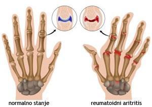 1.1. Osnovne karakteristike Reumatoidni artritis je kronična, sistemska, upalna, progresivna, autoimuna bolest koja je karakterizirana fazama egzacerbacije i fazama remisije bolesti a prvenstveno