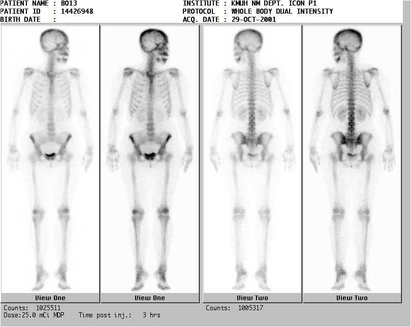 4.7. Scintigrafija skeleta Scintigrafija je neinvazivna dijagnostička metoda kojom se snima raspodjela radioaktivnih tvari, koji emitiraju gama-zračenje i koji se nakupljaju u pojedinim organima ili