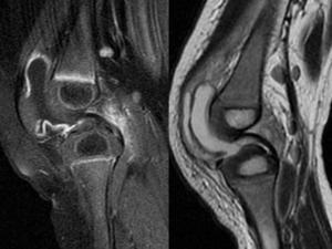 4.8. Kompjuterizirana tomografija CT je odlična dijagnostička metoda za prikaz velikih zglobova, za analizu komplikacija upale zglobova i za preoperativnu pripremu.